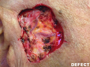 Grafts Case 3016 Defect Photo Grafts