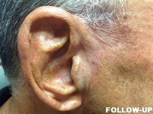 Grafts Case 3016 Follow Up Photo Grafts