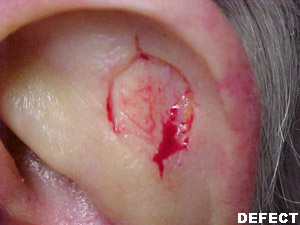 Grafts Case 3028 Defect Photo Grafts