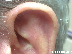 Grafts Case 3028 Follow Up Photo Grafts