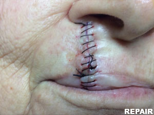 Linear Repairs Case 3155 Repair Photo Linear Repairs